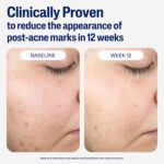 CETAPHIL Gentle Clear Repairing Post-Acne Serum, Retinol Alternative, Oil Free Serum for Sensitive Skin, 1 Fl Oz, Bakuchiol, Improves Skin Tone & Post-acne Marks, Dermatologist Recommended Brand - Image 5