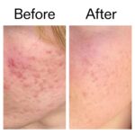 The INKEY List SuperSolutions Azelaic Acid 10% Serum, Fast-Absorbing Formula Helps Reduce Appearance of Redness and Soothes Skin, Leaves No White Cast, 1.01 fl oz - Image 7
